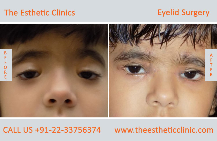 Eyelid Surgery, Blepharoplasty before after photos in mumbai india (8)